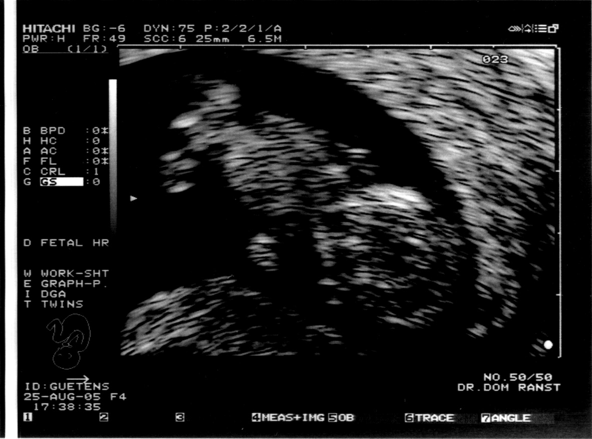 Early_ultrasound